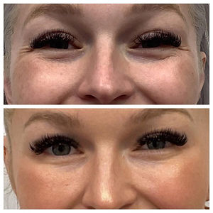 DAXXIFY vs BOTOX Cost Effectiveness Price Per Unit & More